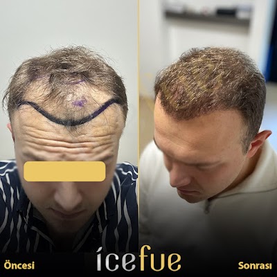 Ice Fue Saç Ekim Merkezi klinik görünümü