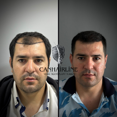 Batman Saç Ekimi - CanHairline klinik görünümü
