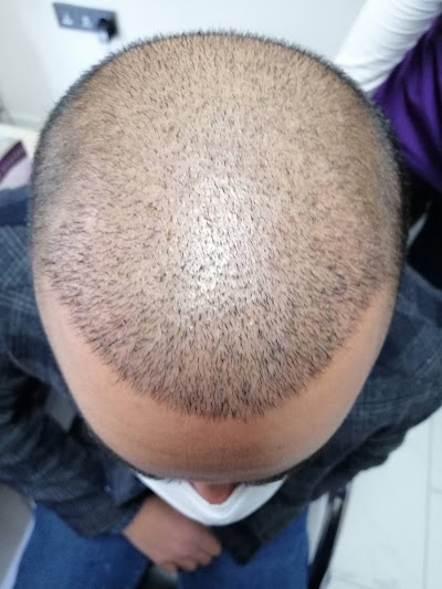 EsteWolf Hair Kayseri Saç Ekimi klinik görünümü
