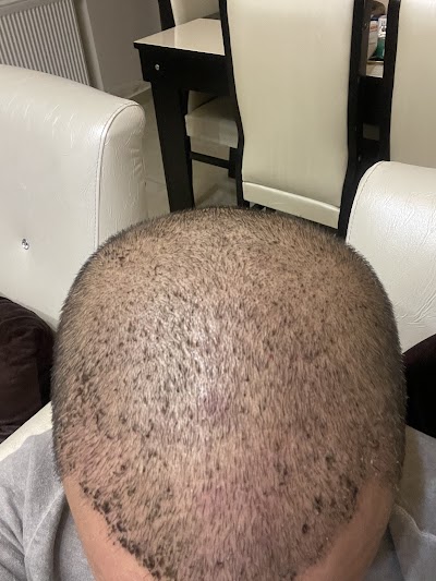 Sonuç Estetik Saç Ekimi klinik görünümü