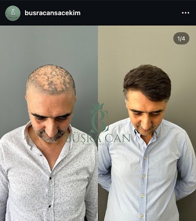 MUĞLA SAÇ EKİM MERKEZİ BÜŞRA CAN SAÇ EKİM MERKEZİ /BÜŞRA CAN HAİR TRANSPLANT klinik görünümü
