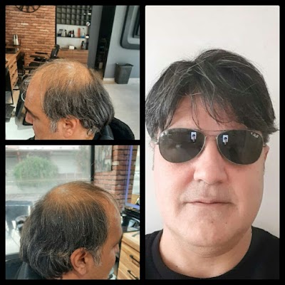 Ahi Protez Saç klinik görünümü