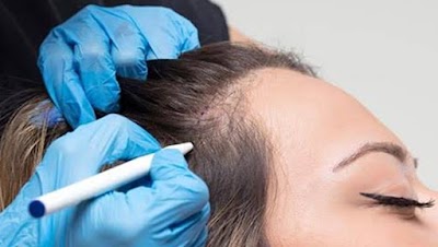 Kadın Saç Ekimi - İstanbul Saç Ekimi klinik görünümü