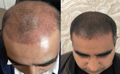 Bayburt Saç Ekim Merkezi klinik görünümü