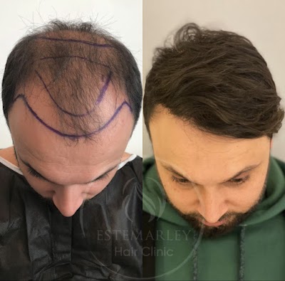 Este Marley | Greffe de Cheveux Turquie | haartransplantatie | Hair Transplant Turkey | Haartransplantation | Saç Ekim | klinik görünümü