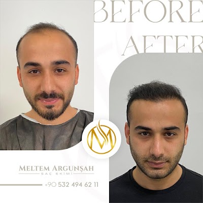 MELTEM ARGUNŞAH SAÇ EKİMİ - DHI, Sapphire & Fue Hair Transplant klinik görünümü