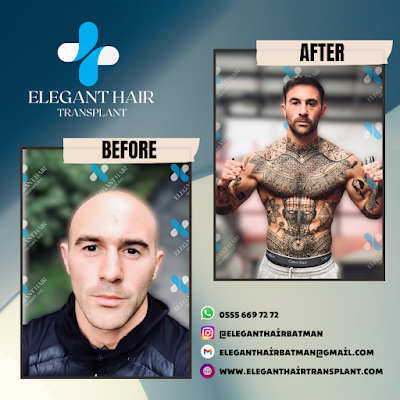 ELEGANT SAÇ EKİM MERKEZİ BATMAN klinik görünümü
