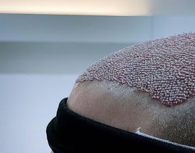 Ankara Saç Ekimi (Naturelhair) klinik görünümü
